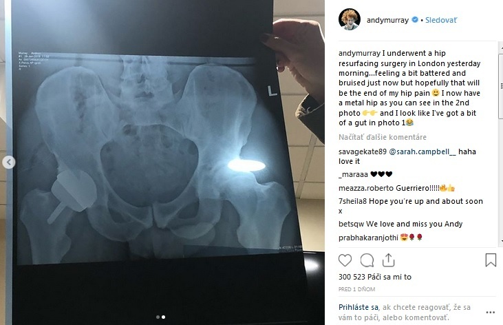 Murrayho röntgenový snímok sa