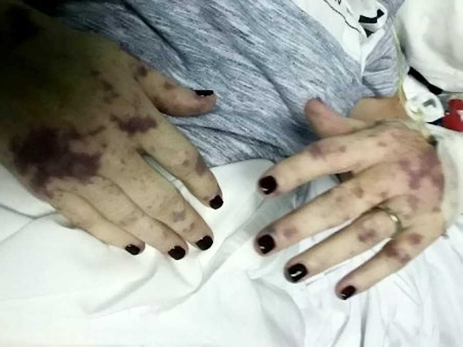 Ruky jej pokryli fialové
