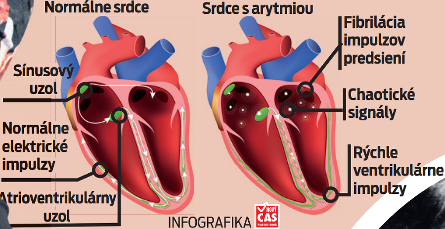 Príznaky srdcovej arytmie.