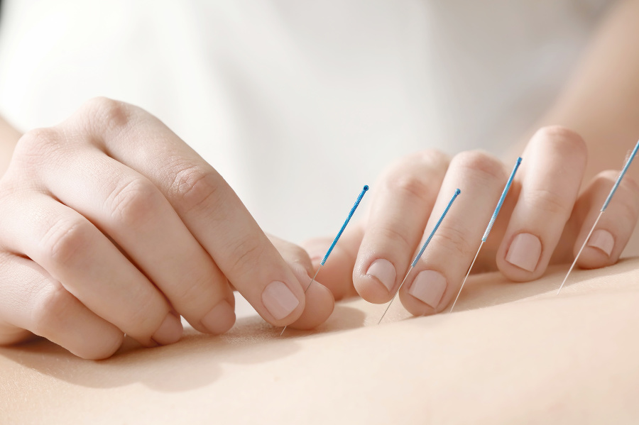Young woman undergoing acupuncture