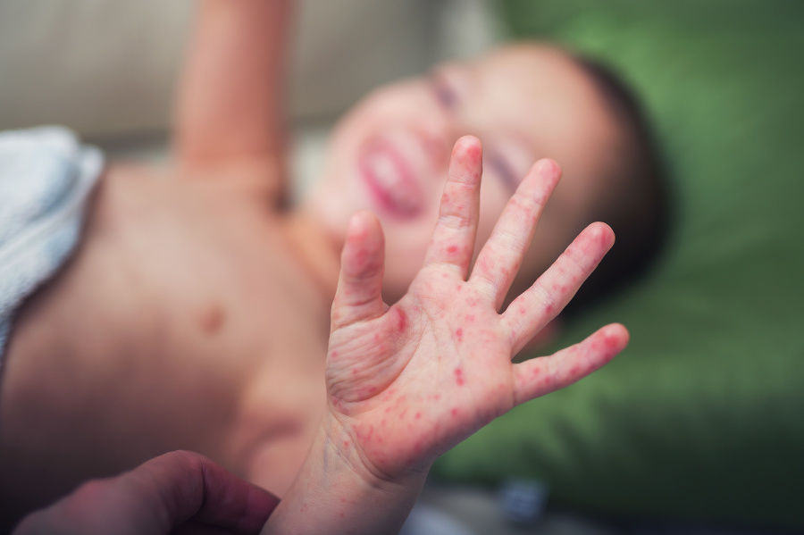 Boy with symptoms hand,