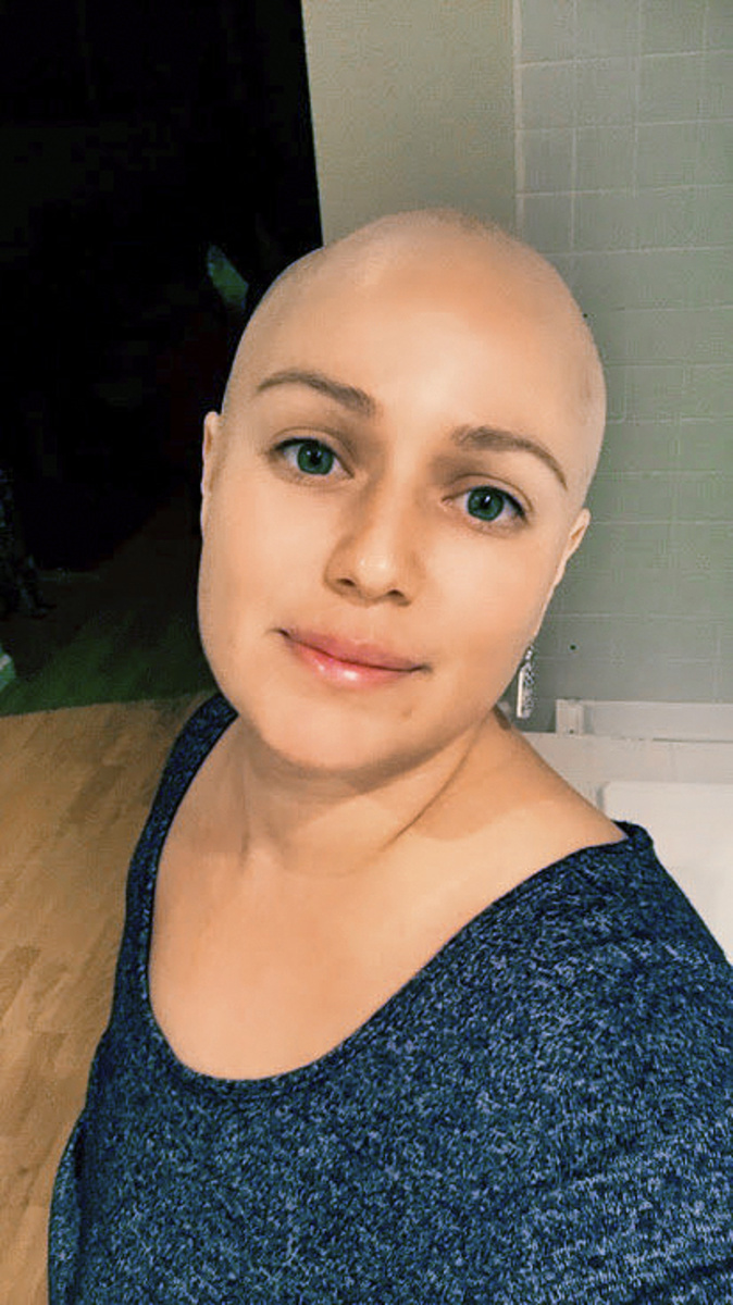 Takto ju zmenila chemoterapia.