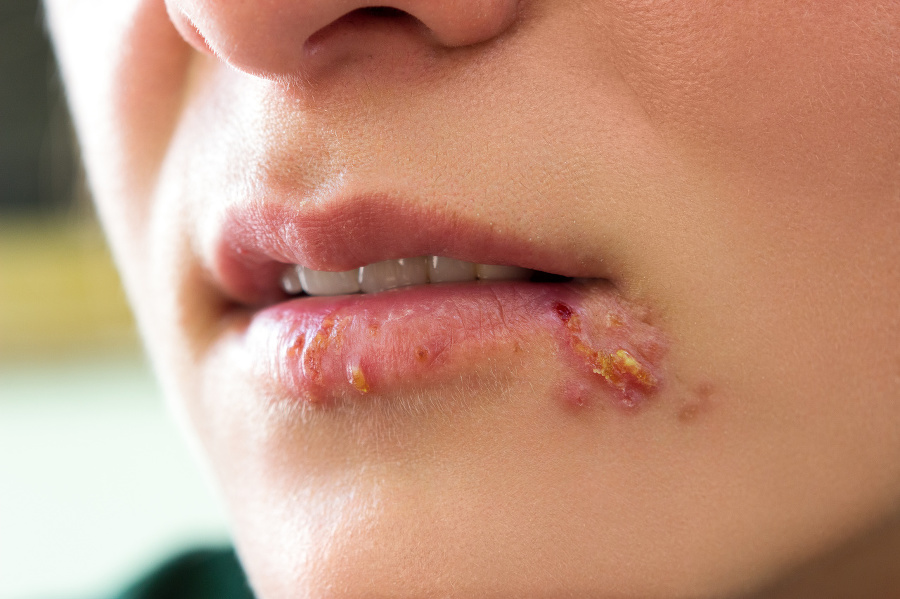 Girl lips showing herpes