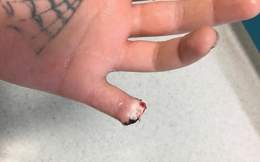 Odrezaný kúsok prsta nosí