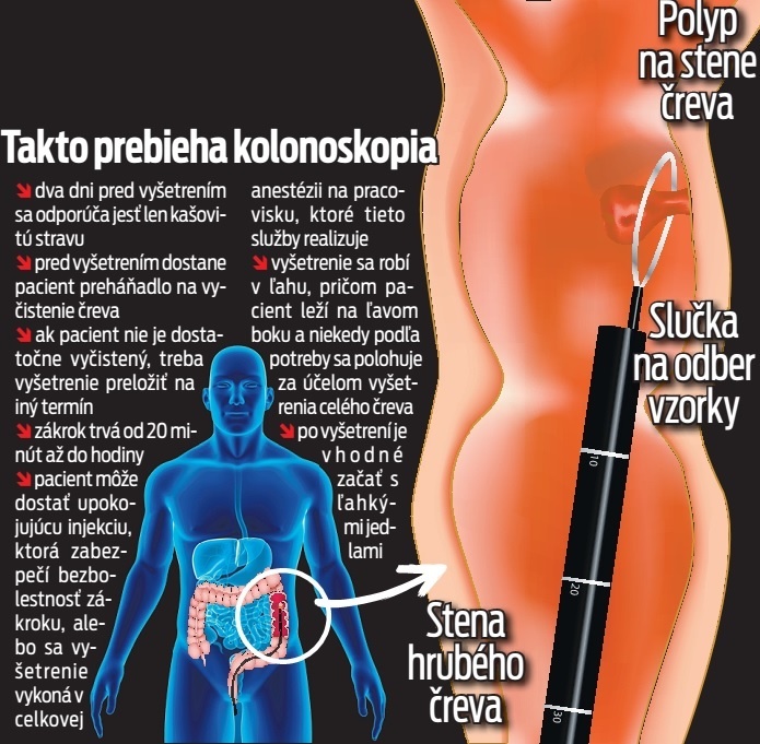 Takto prebieha kolonoskopia.