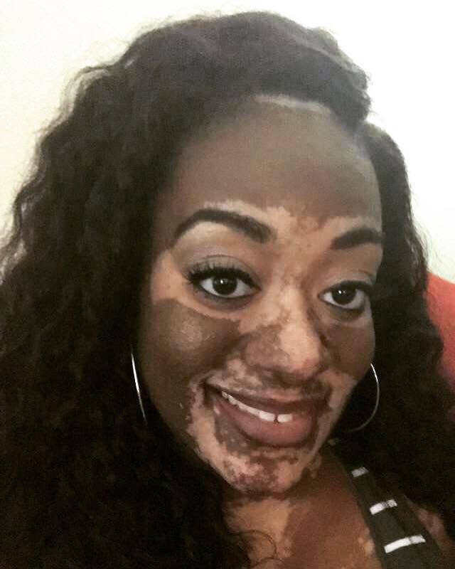 Kandice Benford má vitiligo.