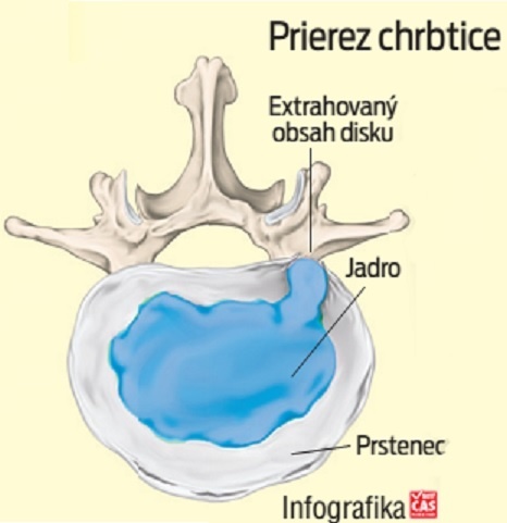 Prierez chrbtice.