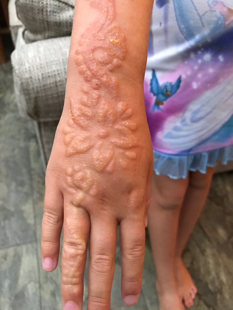 Hrôzostrašné následky tetovania hennou.