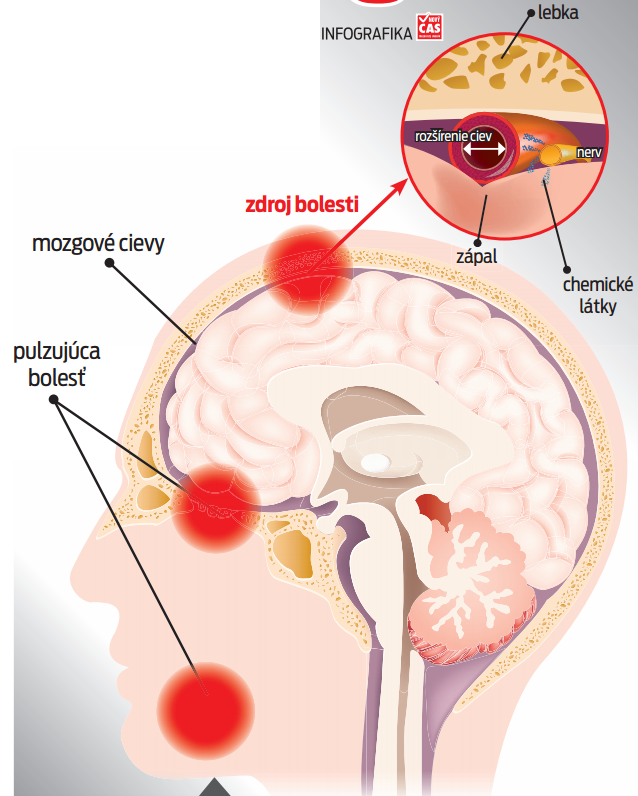 Krutými bolesťami hlavy trpia