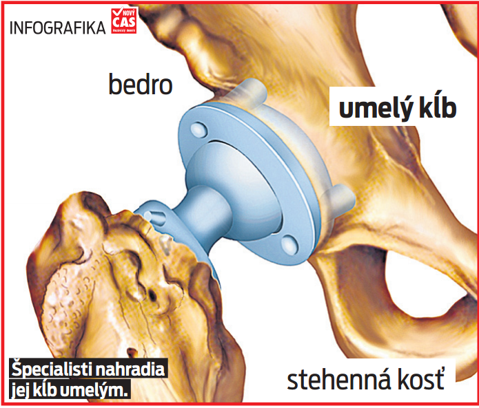 Špecialisti nahradia jej kĺb