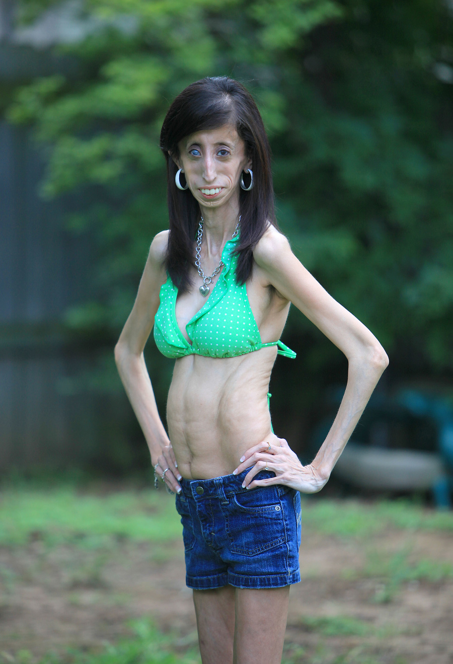 Lizzie Velasquez