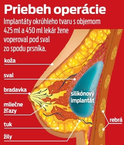 Priebeh operácie.