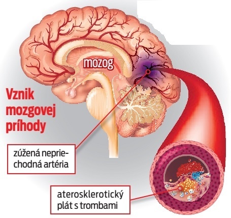 Vznik mozgovej príhody.