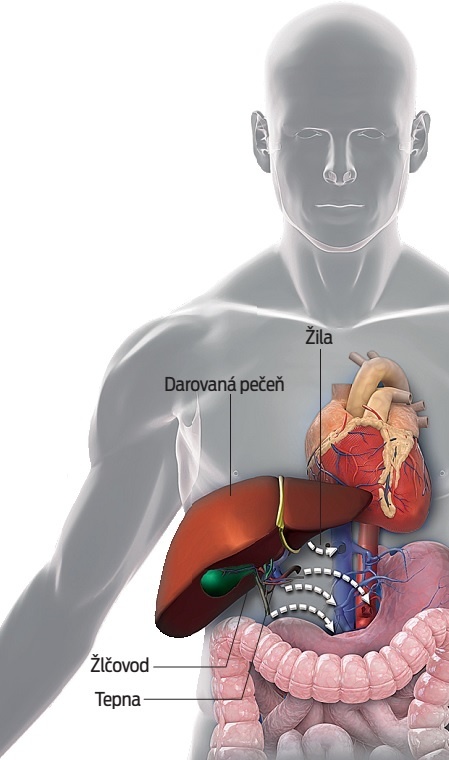 Transplantácia pečeňe.