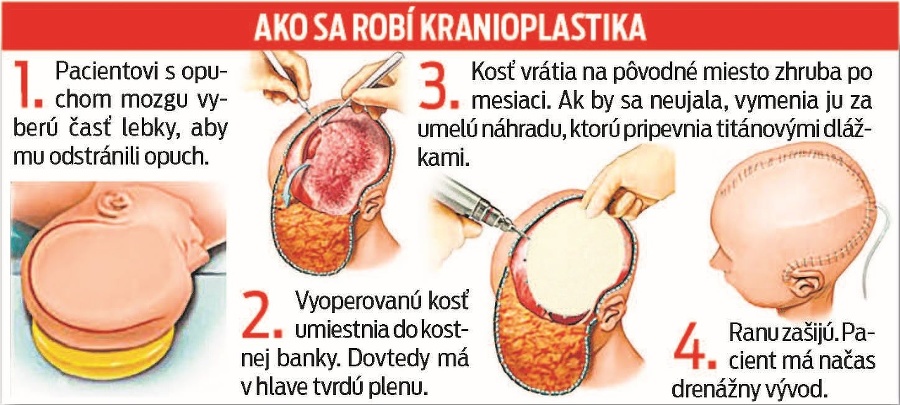 Ako sa robí kranioplastika