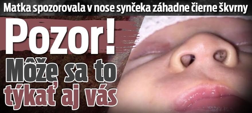 Matka spozorovala v nose