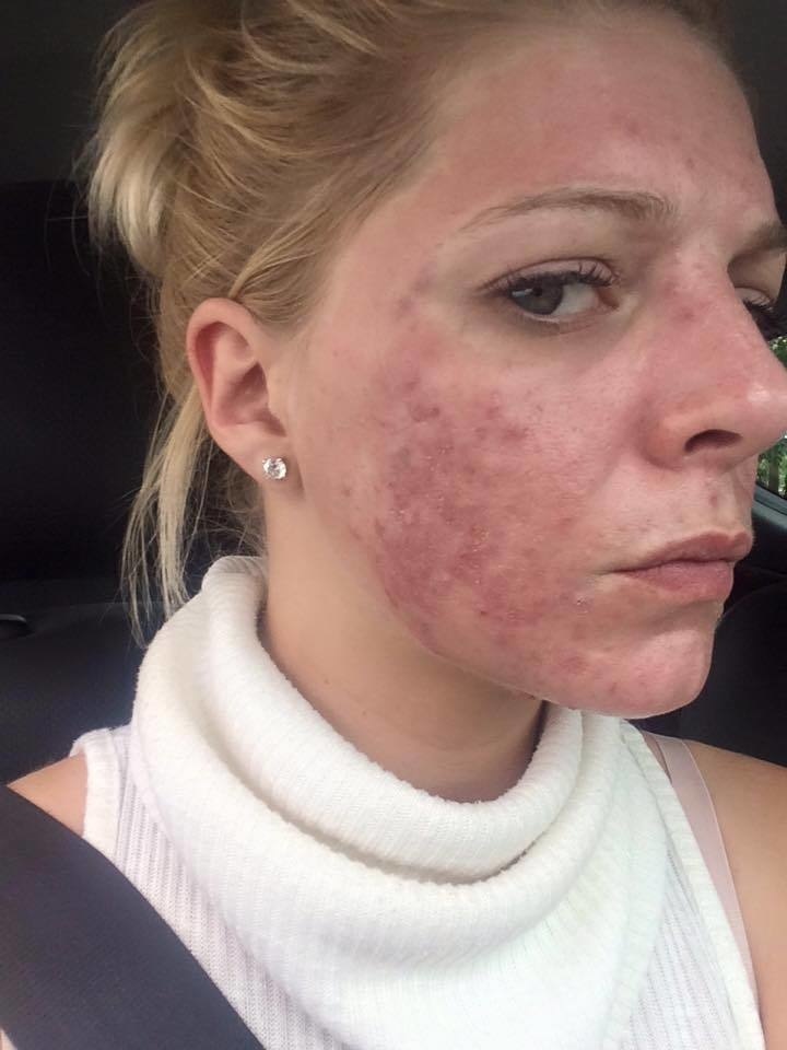 Žena po druhom zákroku. Lekár ju presvedčil, že to bude najlepšie.