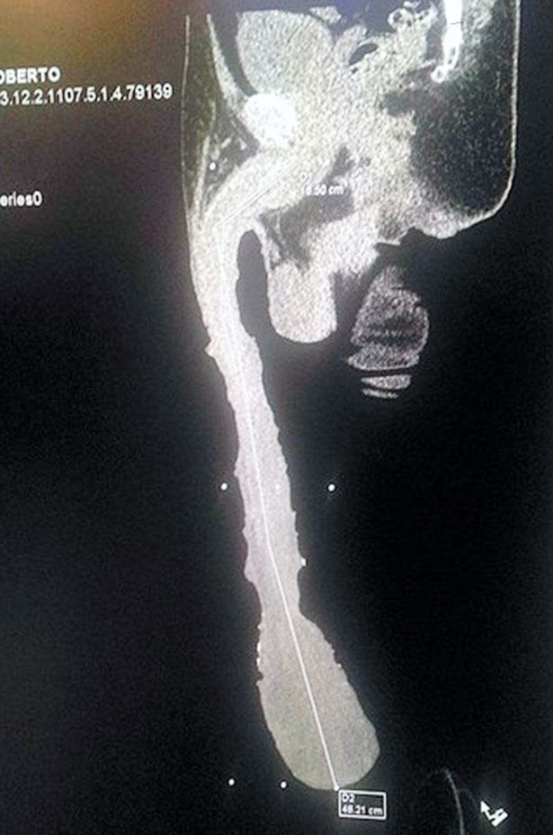 Röntgenová snímka Robertovho penisu