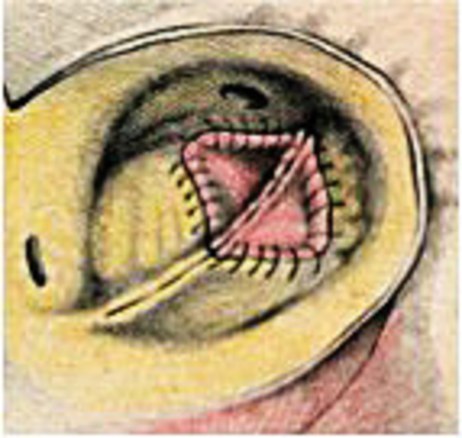 3. S pomocou implantátu