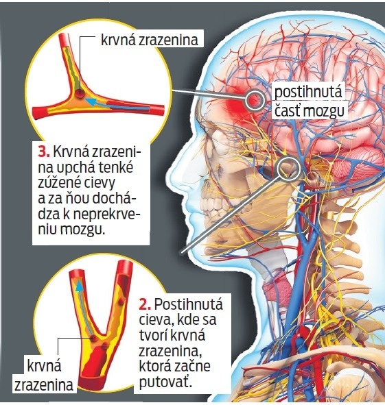 Môže to byť mozgová