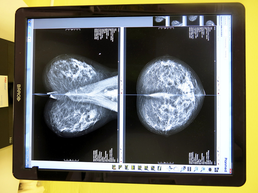 Nový mamograf dokáže včas