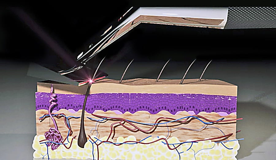 Laser zachytí každý chĺpok