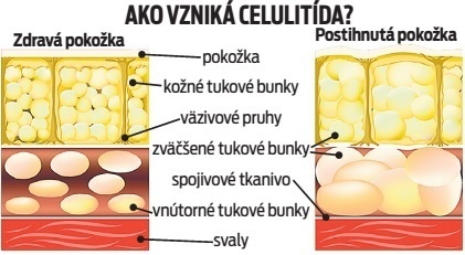 Ako vzniká celulitída?