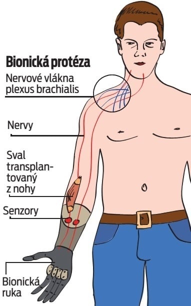 Bionická protéza