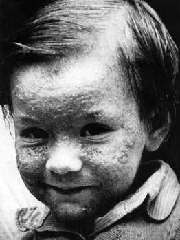 Takto znetvoril tváre dioxín, ktorý sa dostal do vzduchu po výbuch chemického reaktora v Talianskom Sevese v roku 1976.