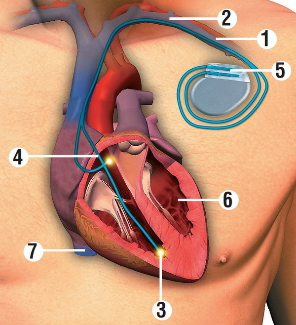 Ako funguje kardiostimulátor