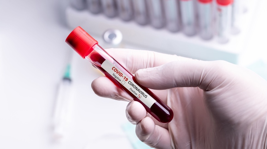 Doctor wearing medical gloves holding a blood tube with positive Coronavirus 2019-nCoV Blood Sample.