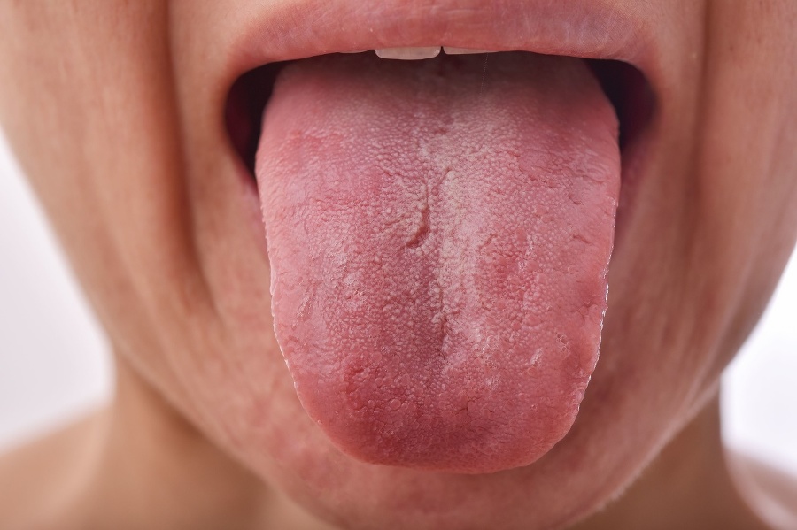 Tongue problem disease, Fissured