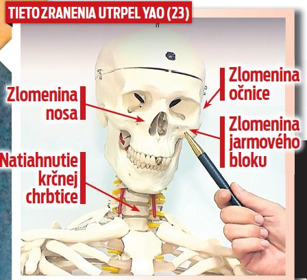 Aké utrpel zranenia.