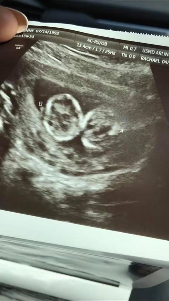Snímku z ultrazvuku našli