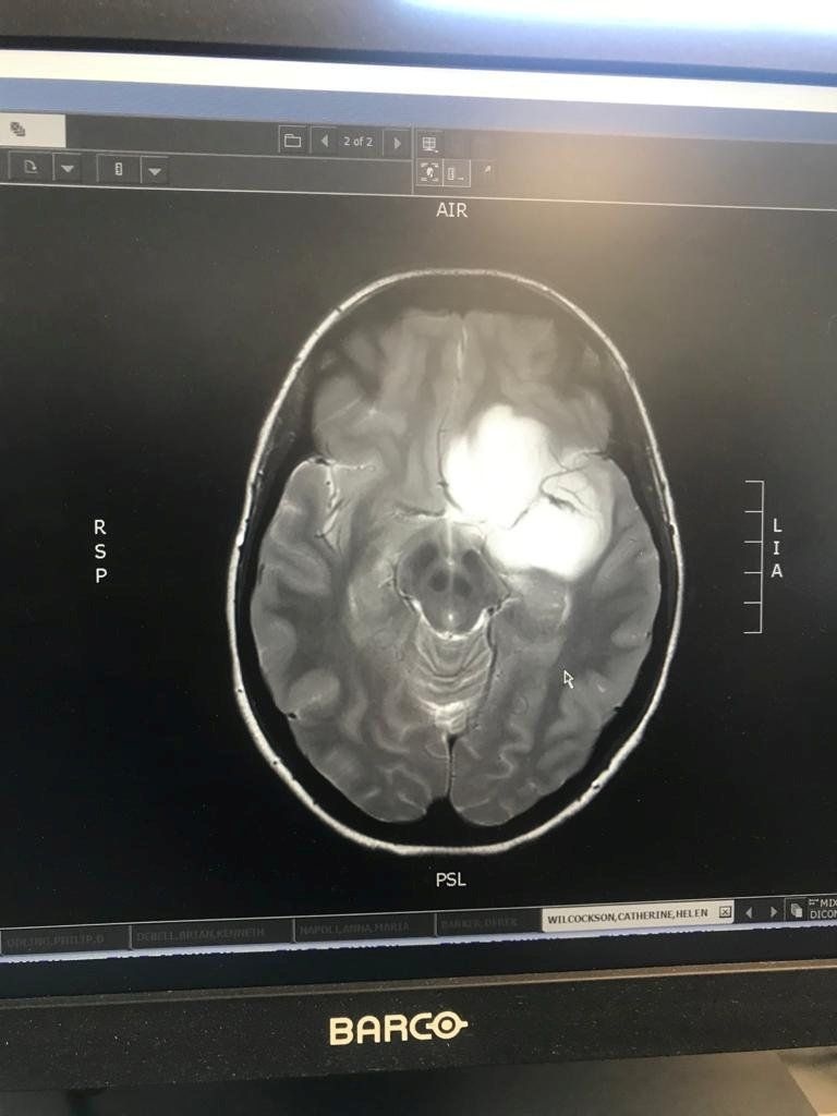 CT odhalilo v hlave