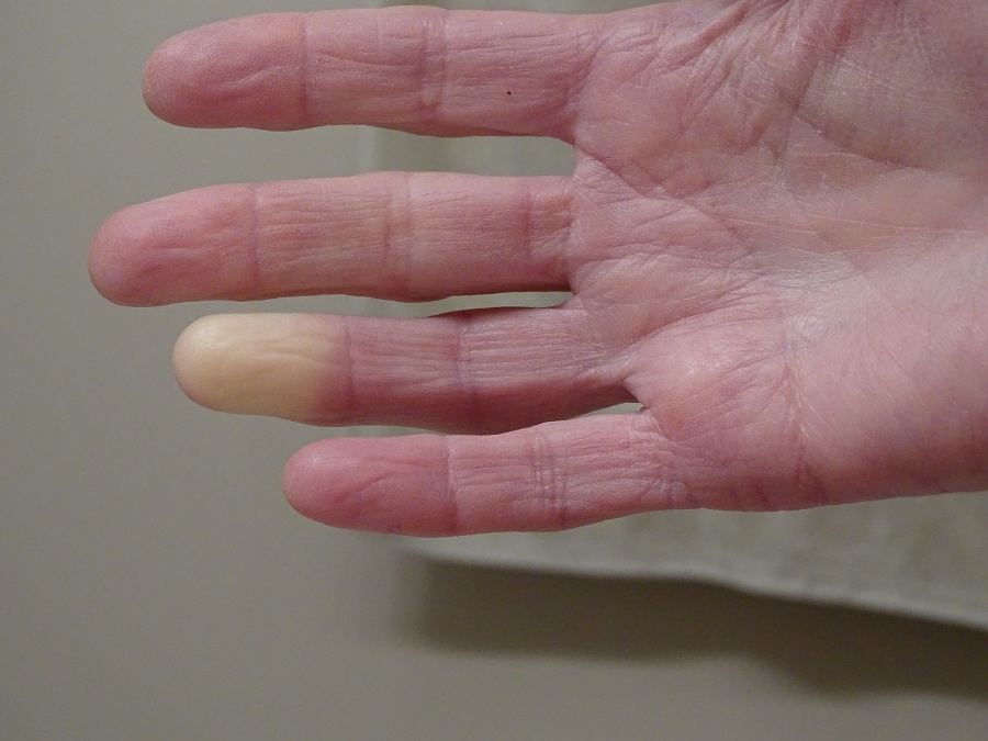 Adult hand with Raynaud’s
