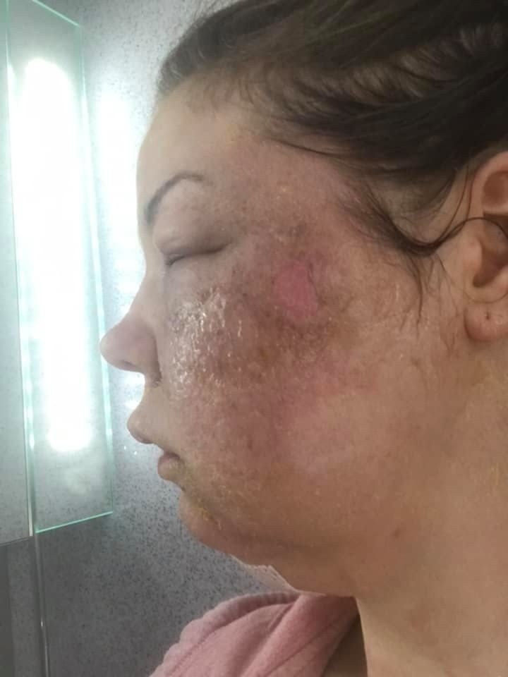 Dvojnásobná mama začala kričať na manžela Johnnyho a utekala do kúpeľne, kde si popálenú pokožku chladila vodou.