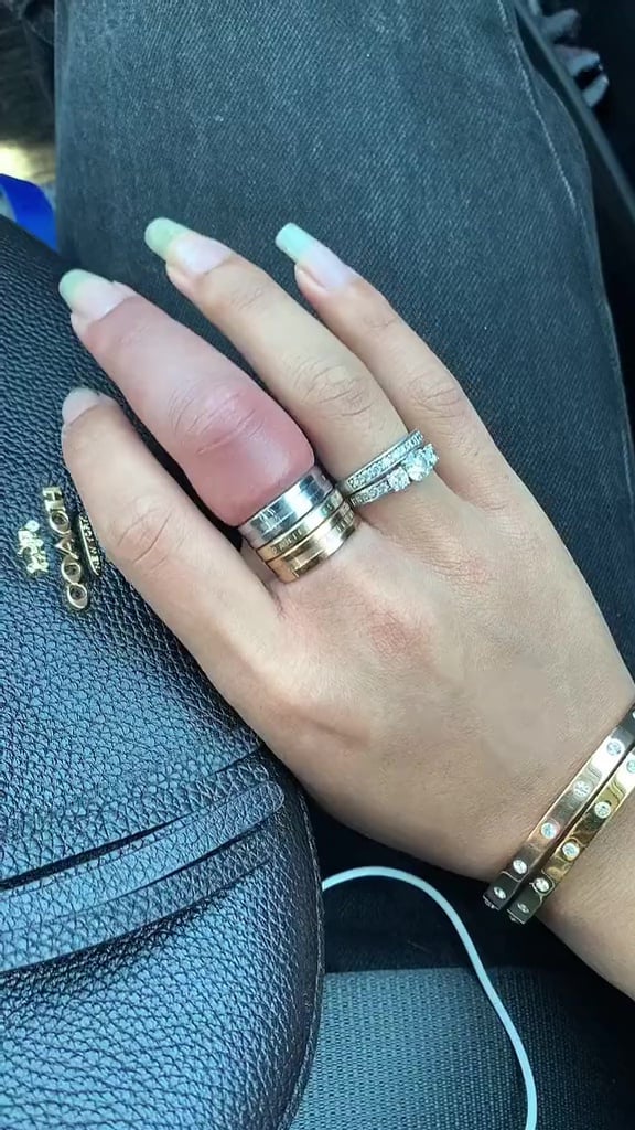 Časť prsta pod prsteňmi bola úplne červená, zatiaľ čo časť prsta, na ktorej prstene žena nemala bola takmer dvakrát taká veľká.