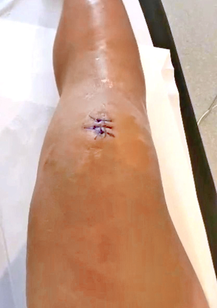 Saganovo operované koleno.