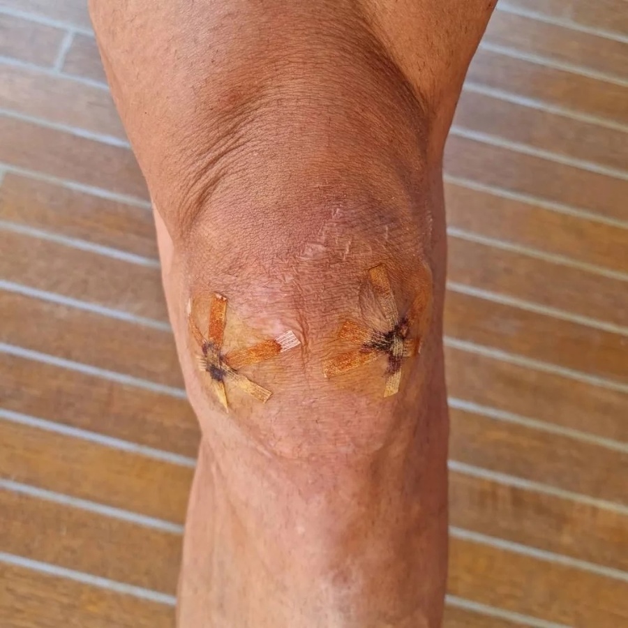 Operované koleno Zlatana Ibrahimoviča.