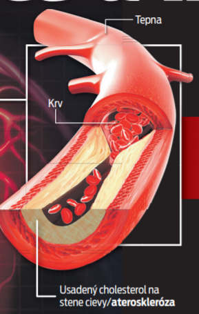 Príznaky aterosklerózy a zasiahnuté orgány