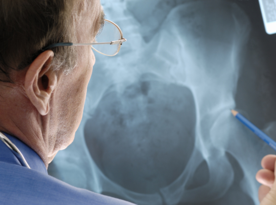 Pri osteoporóze sú kosti