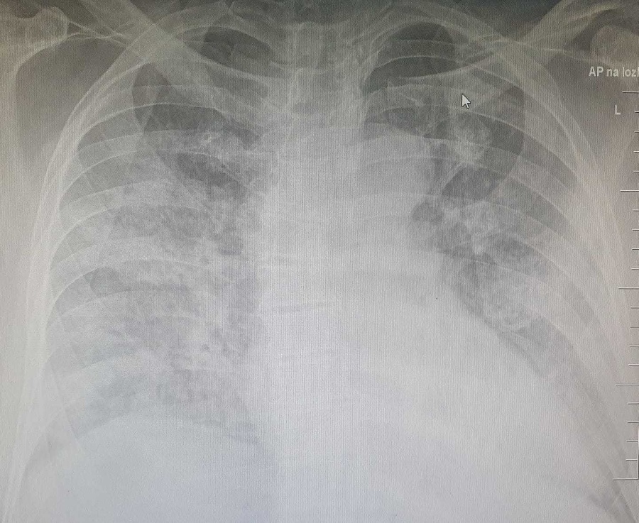 Snímka pľúc pacienta, ktorý sa liečil ivermektínom.