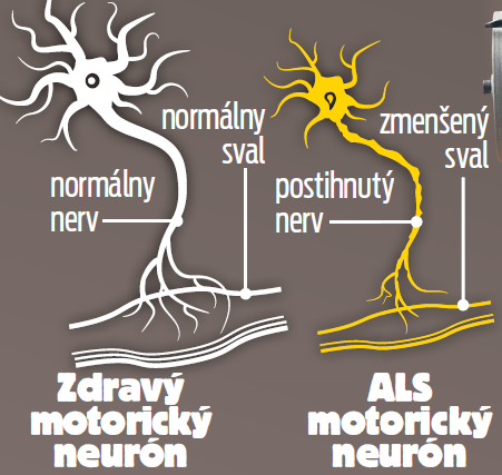 Zákerná ALS.