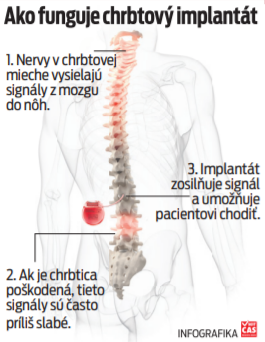 Ako funguje chrbtový implantát