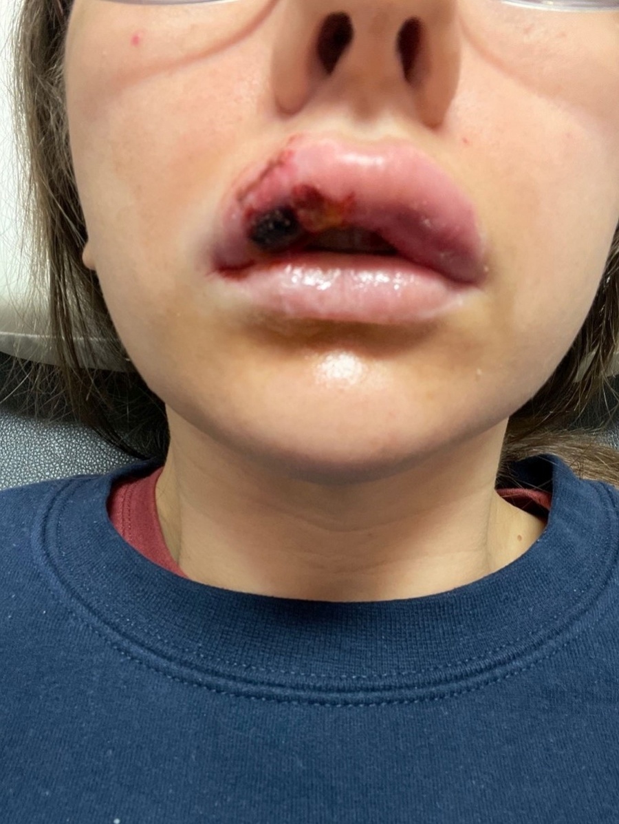 Paige Bellingerová takmer prišla o polovicu tváre.