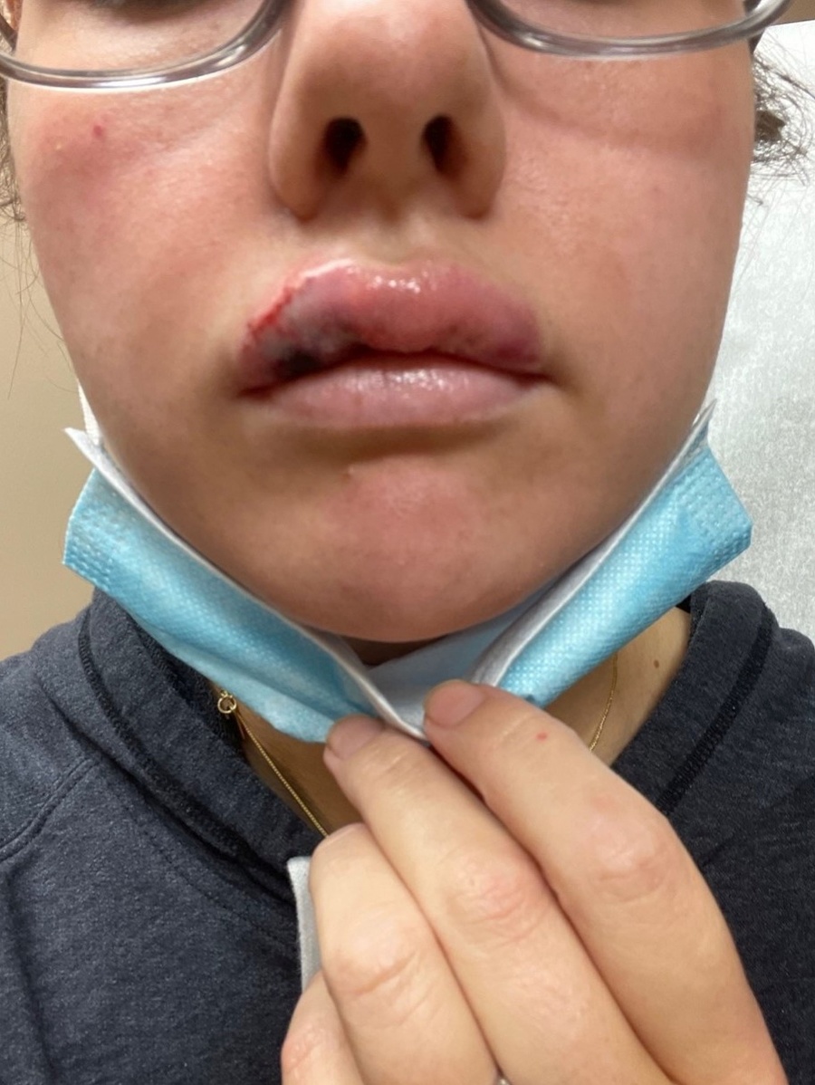 Paige Bellingerová takmer prišla o polovicu tváre.