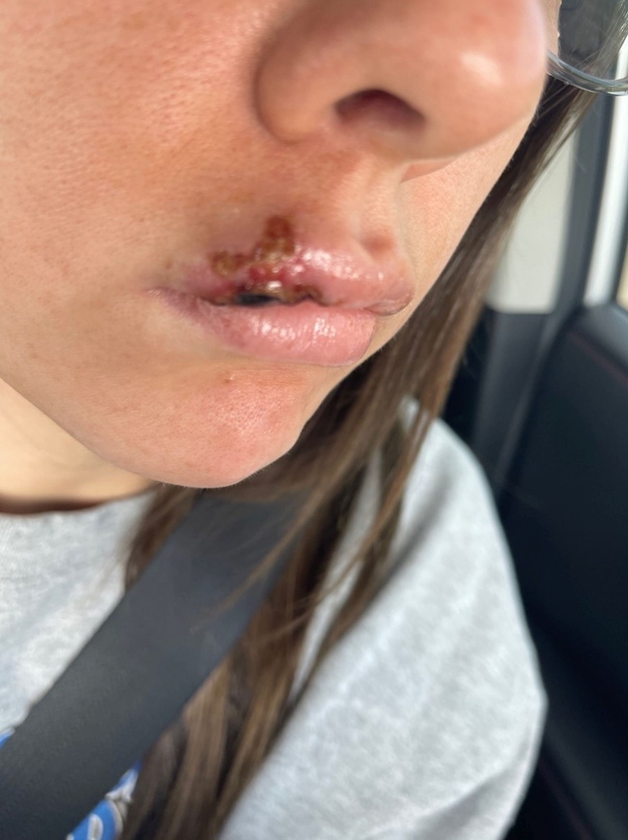 Paige Bellingerová takmer prišla o polovicu tváre.