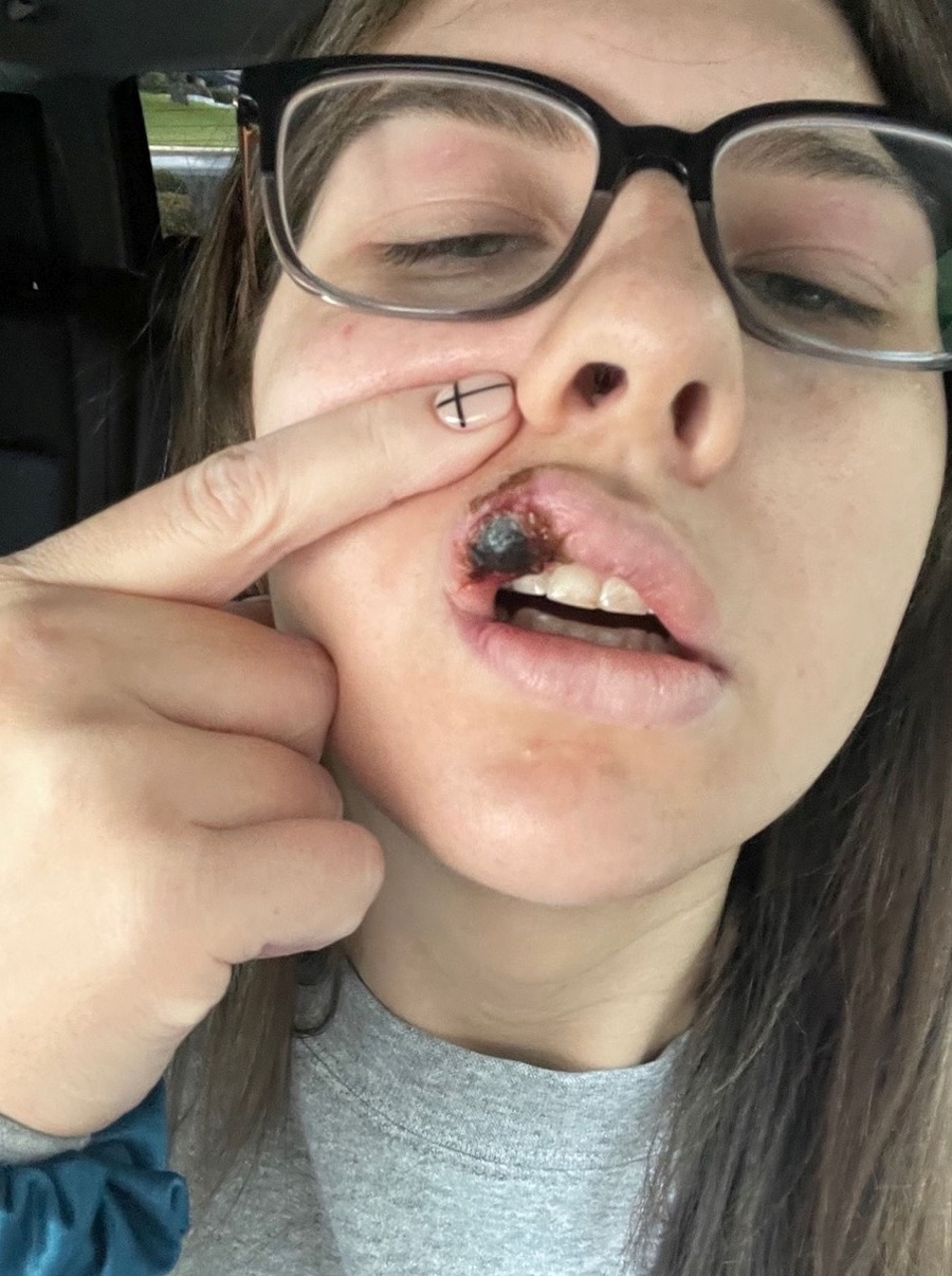 Paige Bellingerová takmer prišla o polovicu tváre.