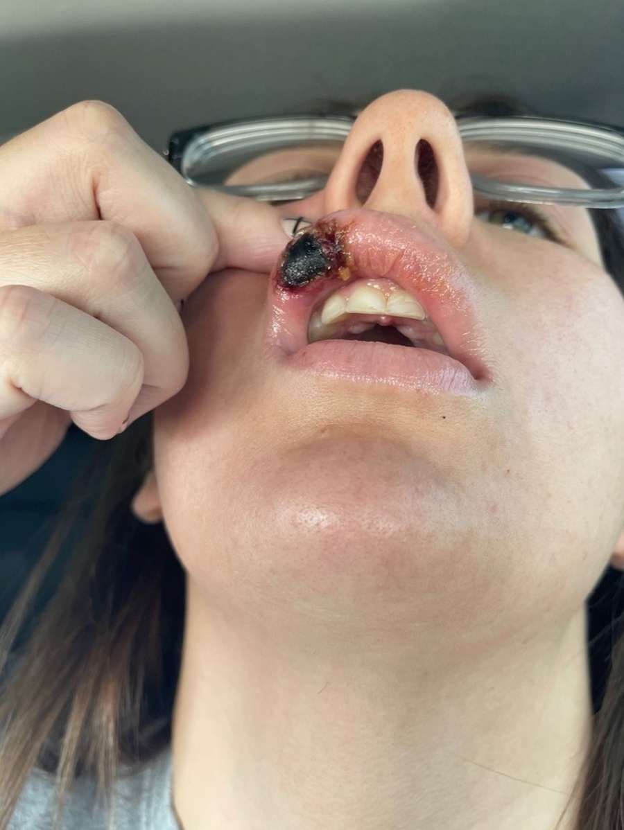 Paige Bellingerová takmer prišla o polovicu tváre.